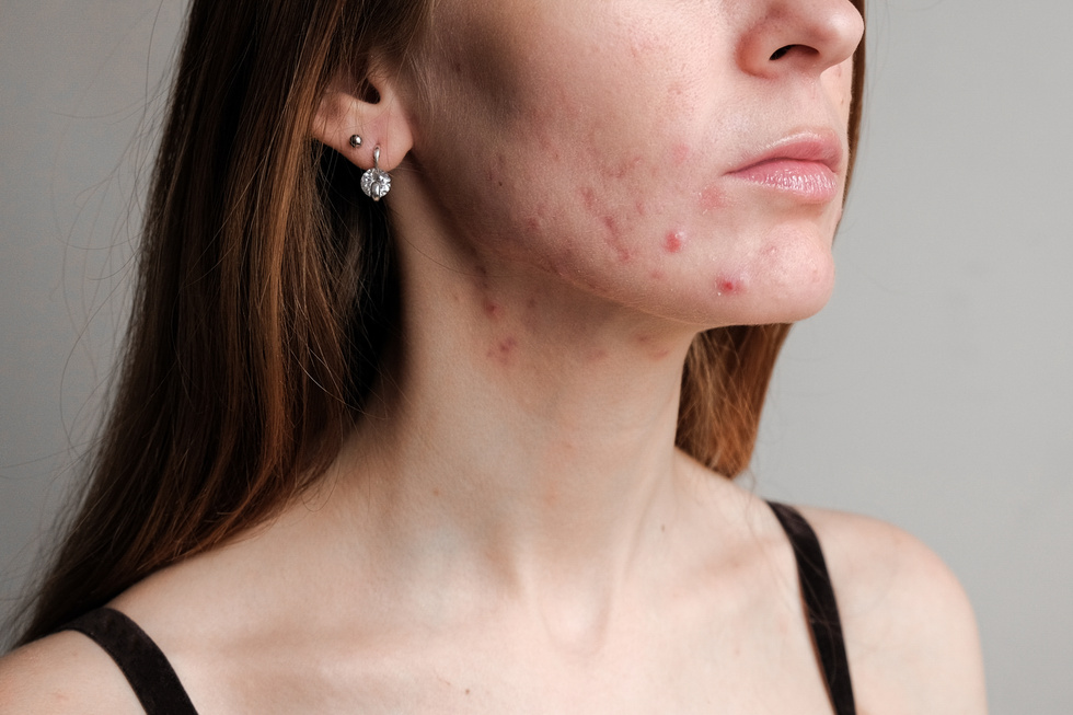 Woman with problem skin. Teen acne on young skin. Tools for removing acne.